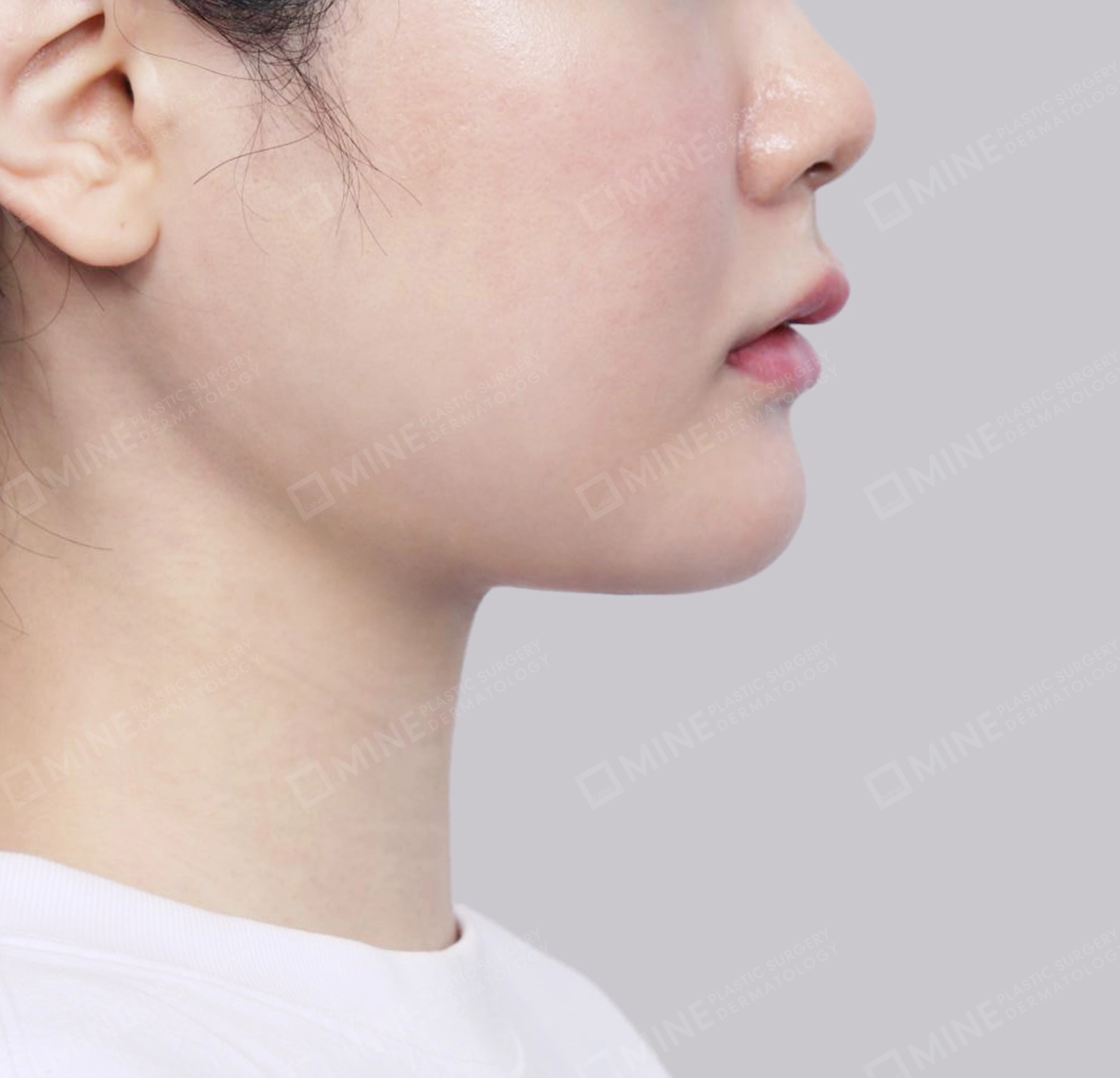 双下巴唾液腺去除-측면-후