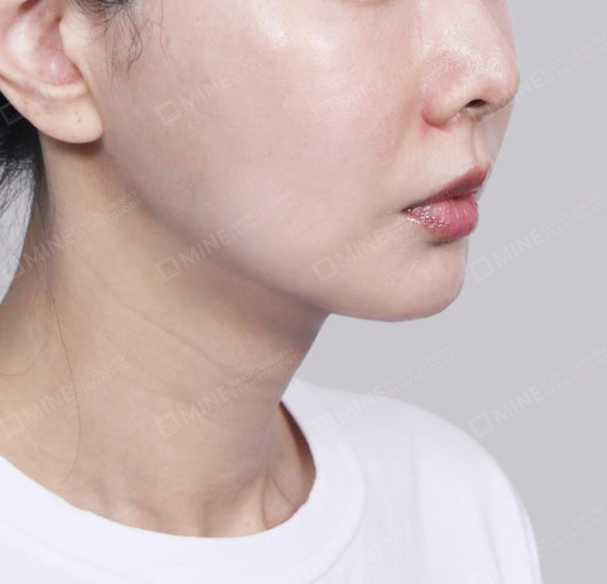 双下巴唾液腺去除-정면-후